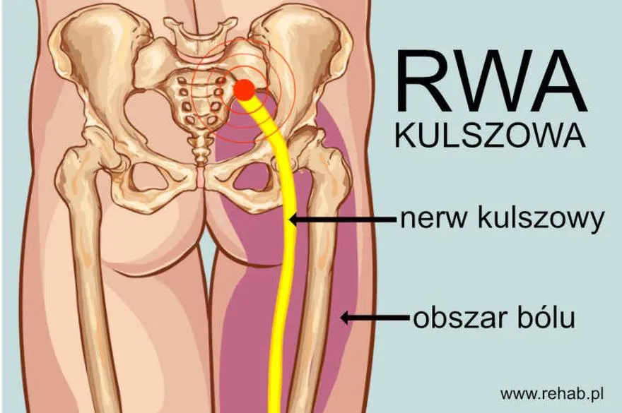 Rehabilitacja po ataku rwy kulszowej