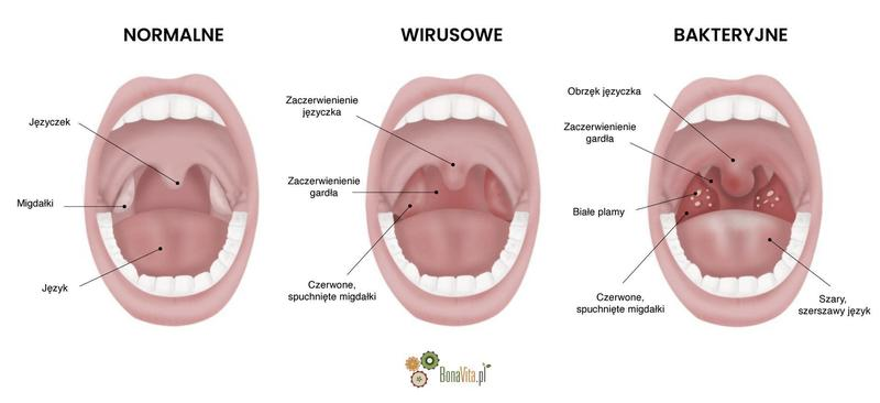 Zwolnienie lekarskie angina